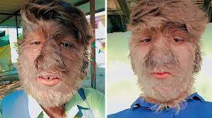 Síndorme del Hombre Lobo Síndorme del Hombre Lobo