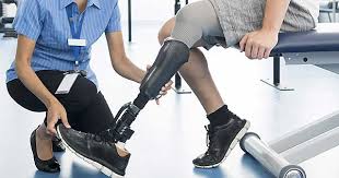 Avances en la tecnología de prótesis para amputados